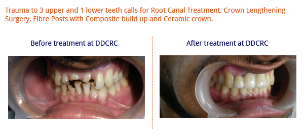 Fractured-teeth-in-an-accident