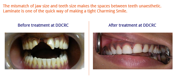 Spaces-between-teeth