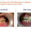 Discolored-teeth