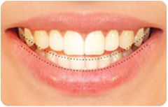 smile-line