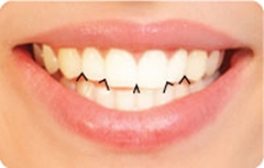 Interincisal-Angles