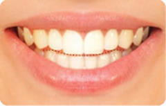 Incisal-edge-configuration