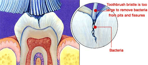 brush-teeth-pit-fissures