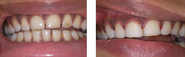 closing-of-space-between-teeth