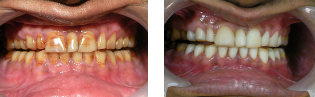 composite-veneering-of-discolored-teeth