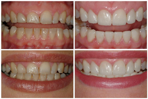 dental-veneers1