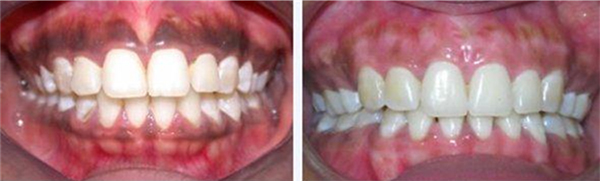 depigmentation-of-gums