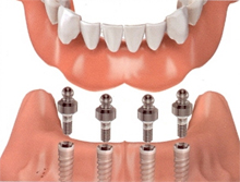implant-supported-overdenture