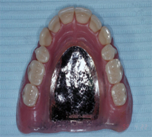 metal-complete-denture