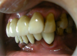 metal-free-ceramic-bridge