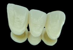 metal-free-ceramic-bridge1