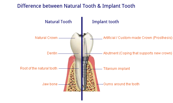 natural-n-implant-tooth