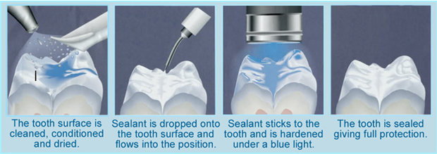 sealants