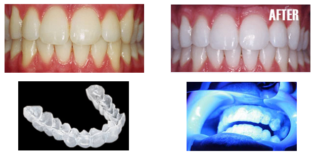 teeth-whitening-1