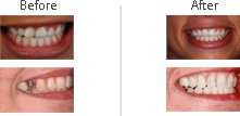 Dental Treatment on Smile