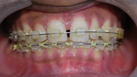 ceramic-braces
