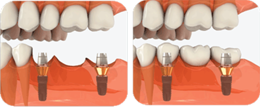 implant-supported-bridge