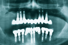 implant-supported-fixed-teeth-x-ray