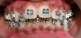 metal-braces