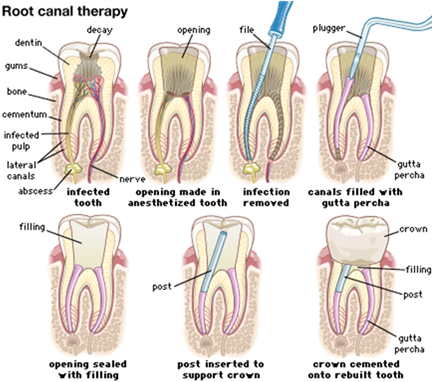 root-canal-therapy
