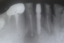 single-tooth-implant-x-ray