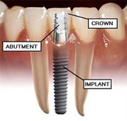 single-tooth-implant