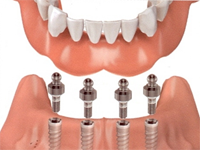 implant-supported-fixed-teeth