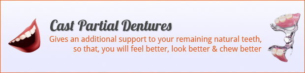cast-partial-dentures