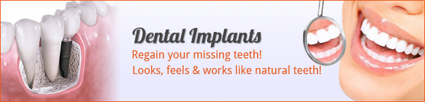 dental-implants