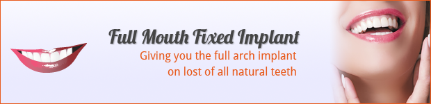 full-mouth-fixed-implant