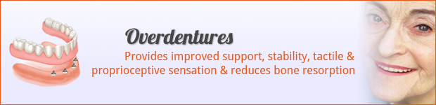overdentures