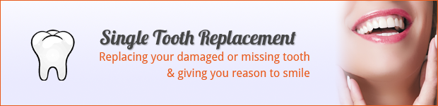 single-tooth-replacement