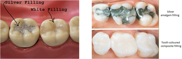silver-filling-composites
