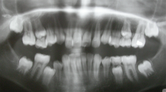 space-regaining-closing-x-ray